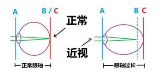 睫状肌长期痉挛无法放松